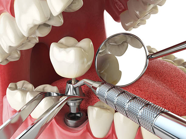Best Emergency Wisdom Teeth Removal in Owensboro, KY